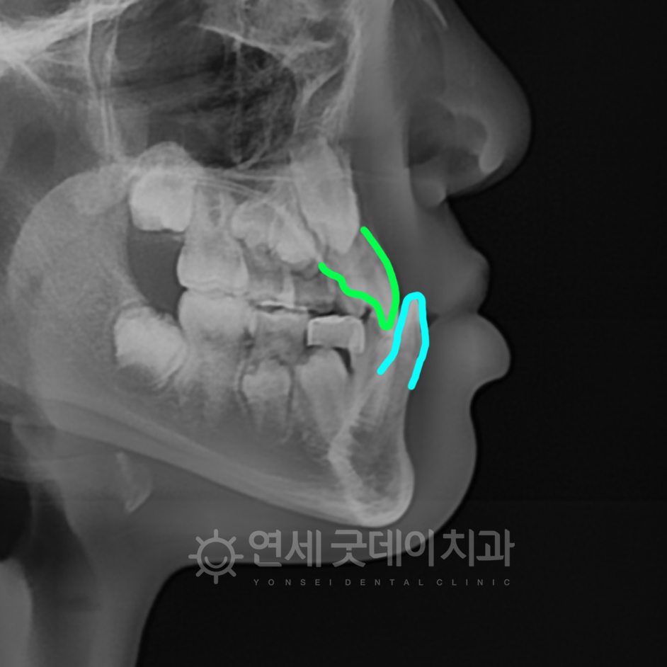 어린이주걱턱교정 전 엑스레이 모습 아랫니가 윗니를 과도하게 덮는 상태