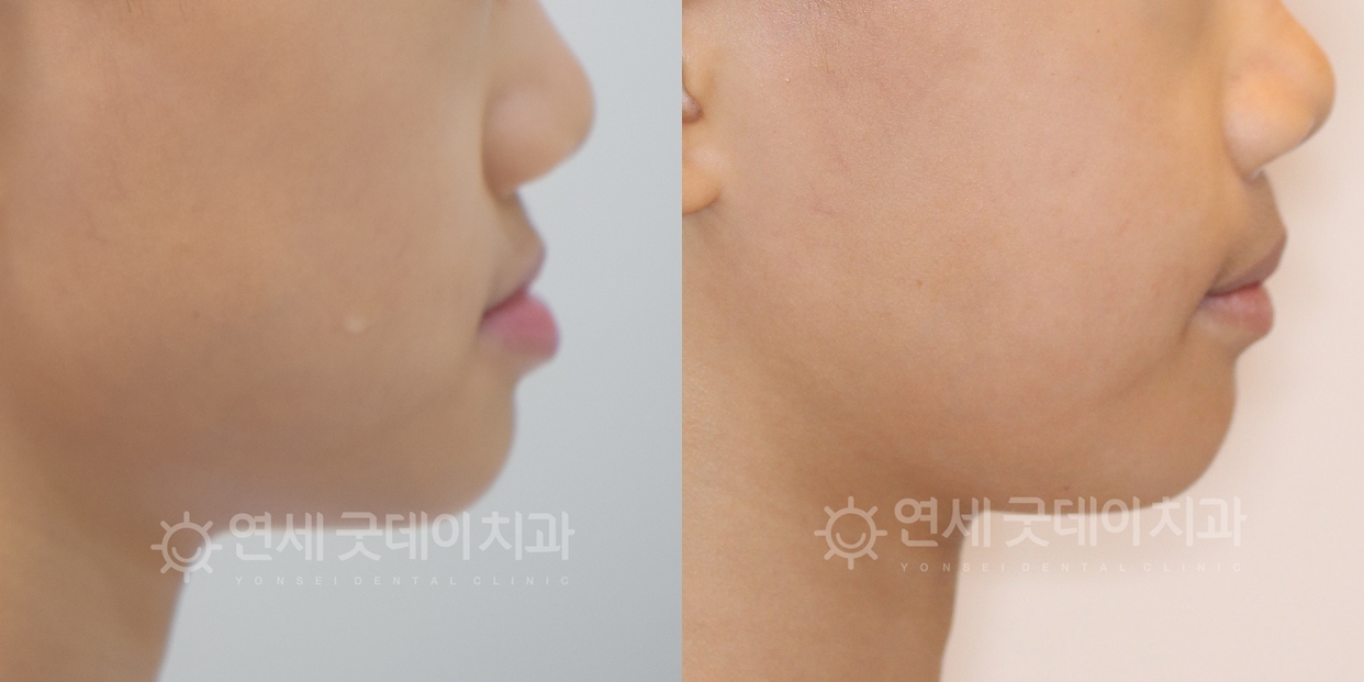 어린이주걱턱교정 페이스마스크 치료 전후 측면모습 비교