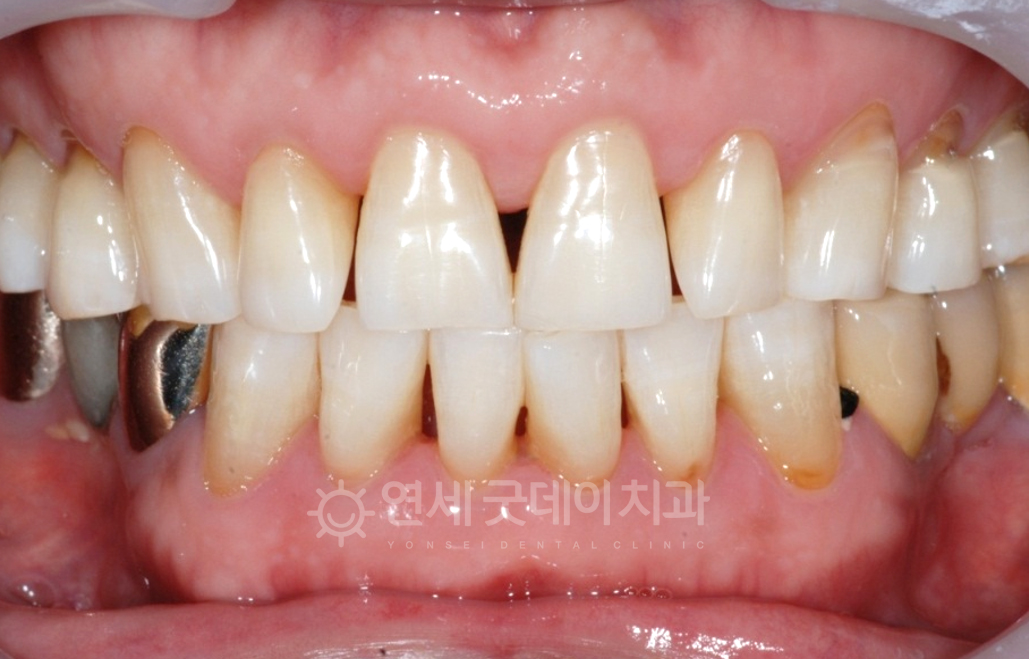 치아미백치료인 원데이치아미백 후 모습이며 치아색이 레벨업되어 한층 밝아졌습니다