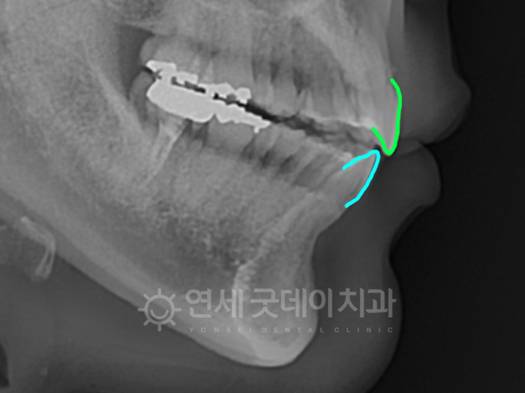 오픈바이트가 드러나는 엑스레이상 모습
