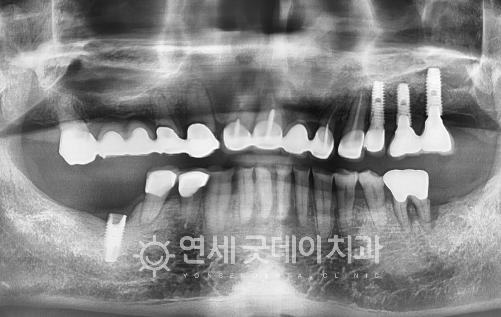 임플란트재수술 치료 전 구강 엑스레이 모습