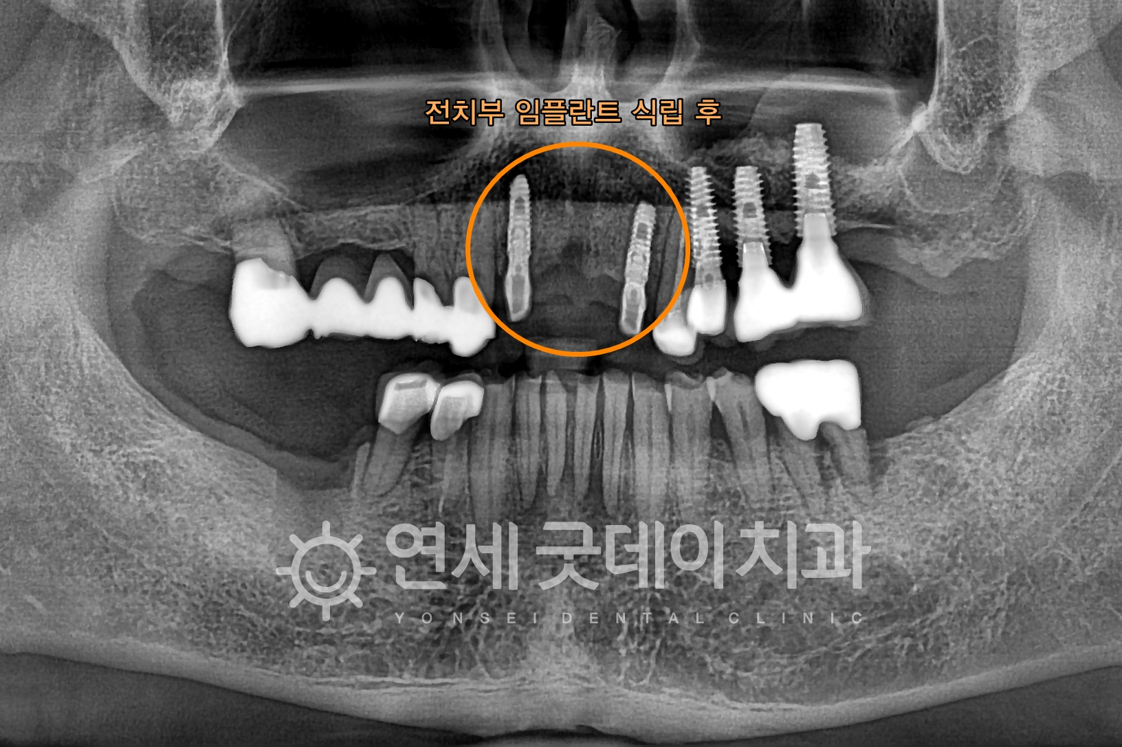 엉망이었던 브릿지 제거 후 전치부 임플란트 식립 후 구강 엑스레이 모습