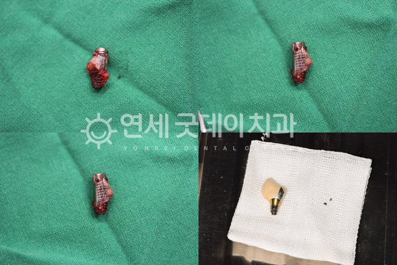 엉망으로 심어진 타원 임플란트제거한 후 잔해들