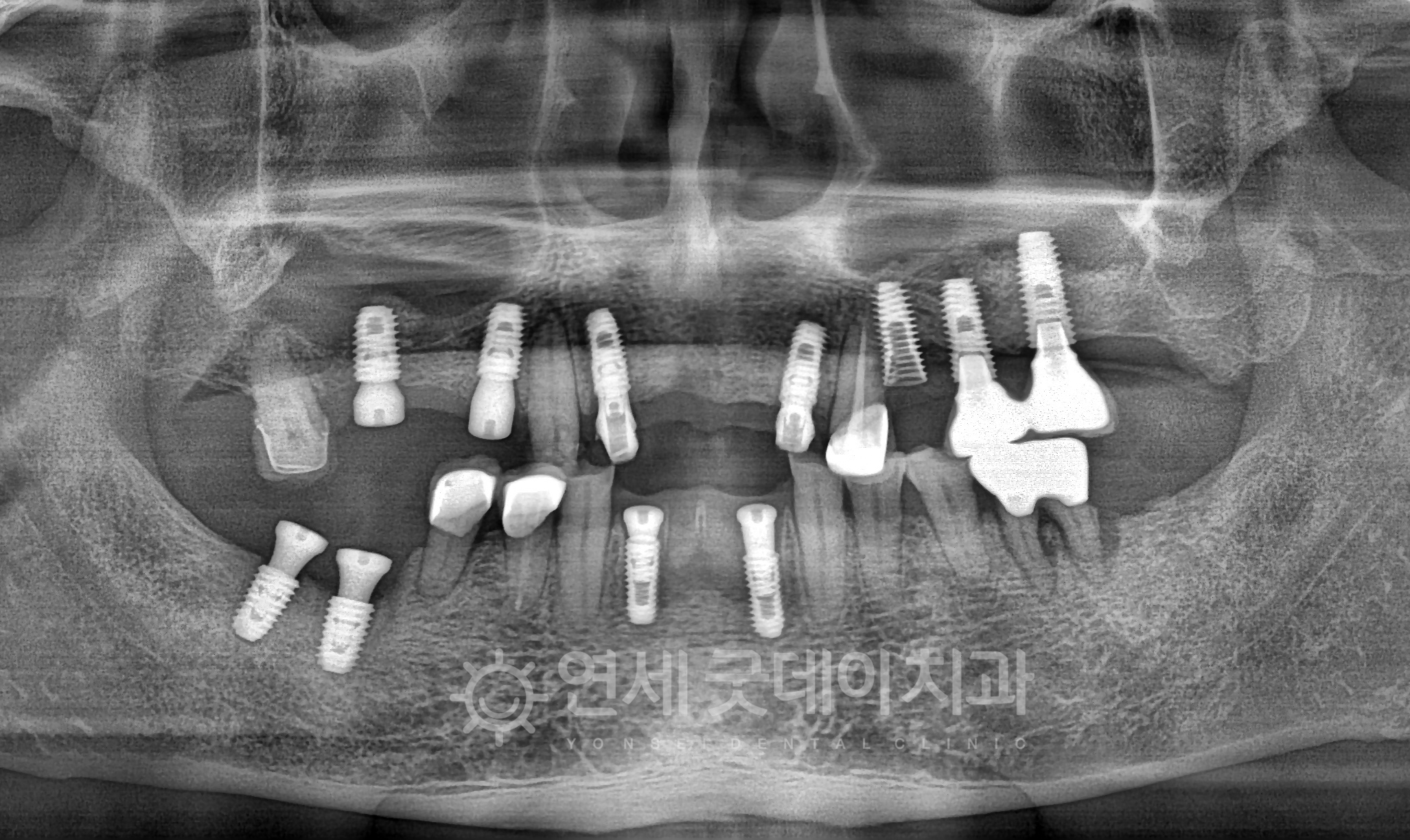 임플란트재수술 진행 중인 엑스레이 모습 브릿지 보철물 제거 후 임플란트 식립 및 상악동거상술 시행