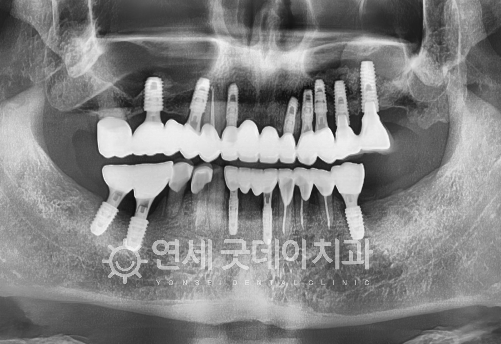 임플란트재수술 치료 완료 후 모습