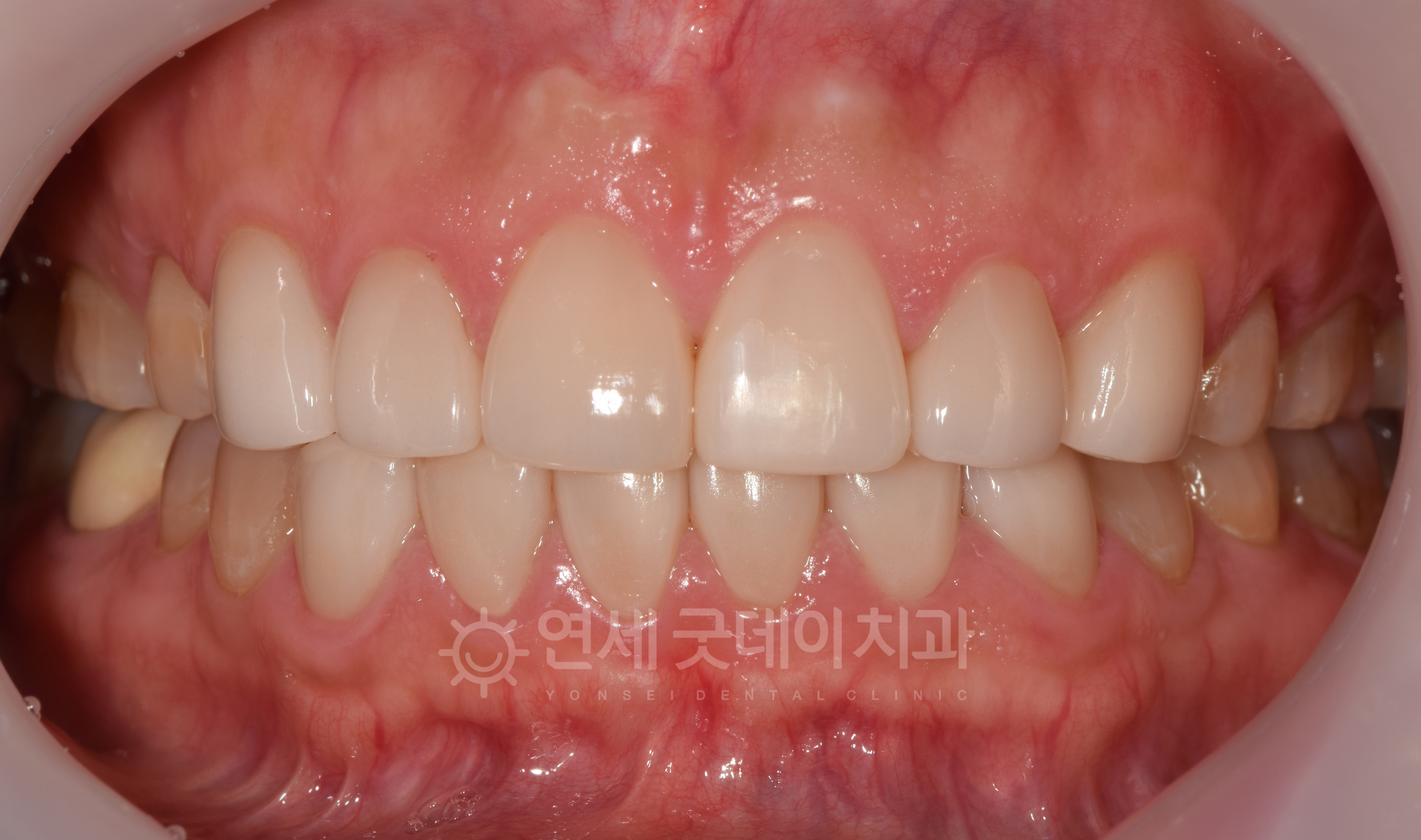 앞니라미네이트까지 완료한 후의 모습