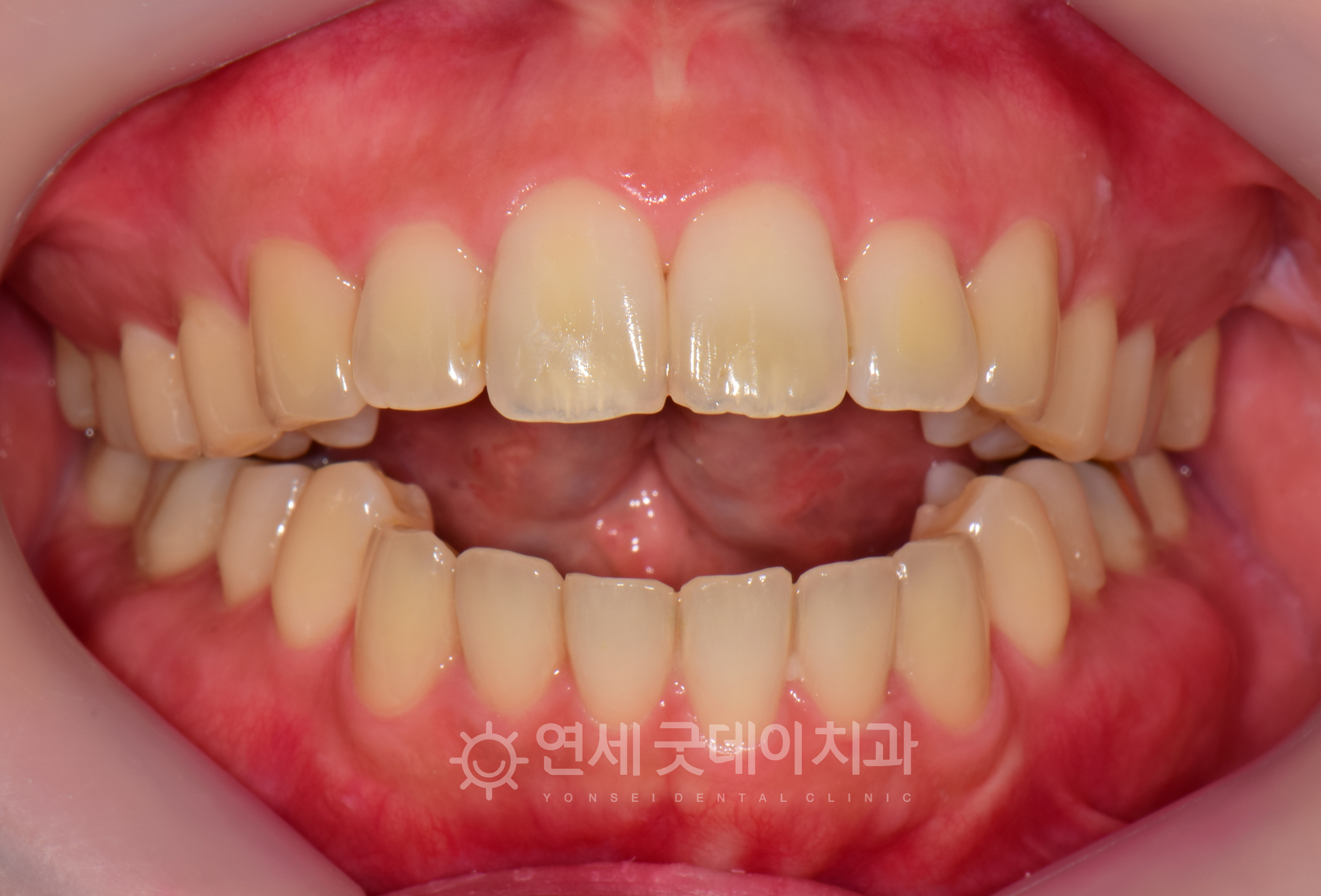 심한 개방교합으로 턱관절교정을 희망하셨던 환자분의 치료전 모습