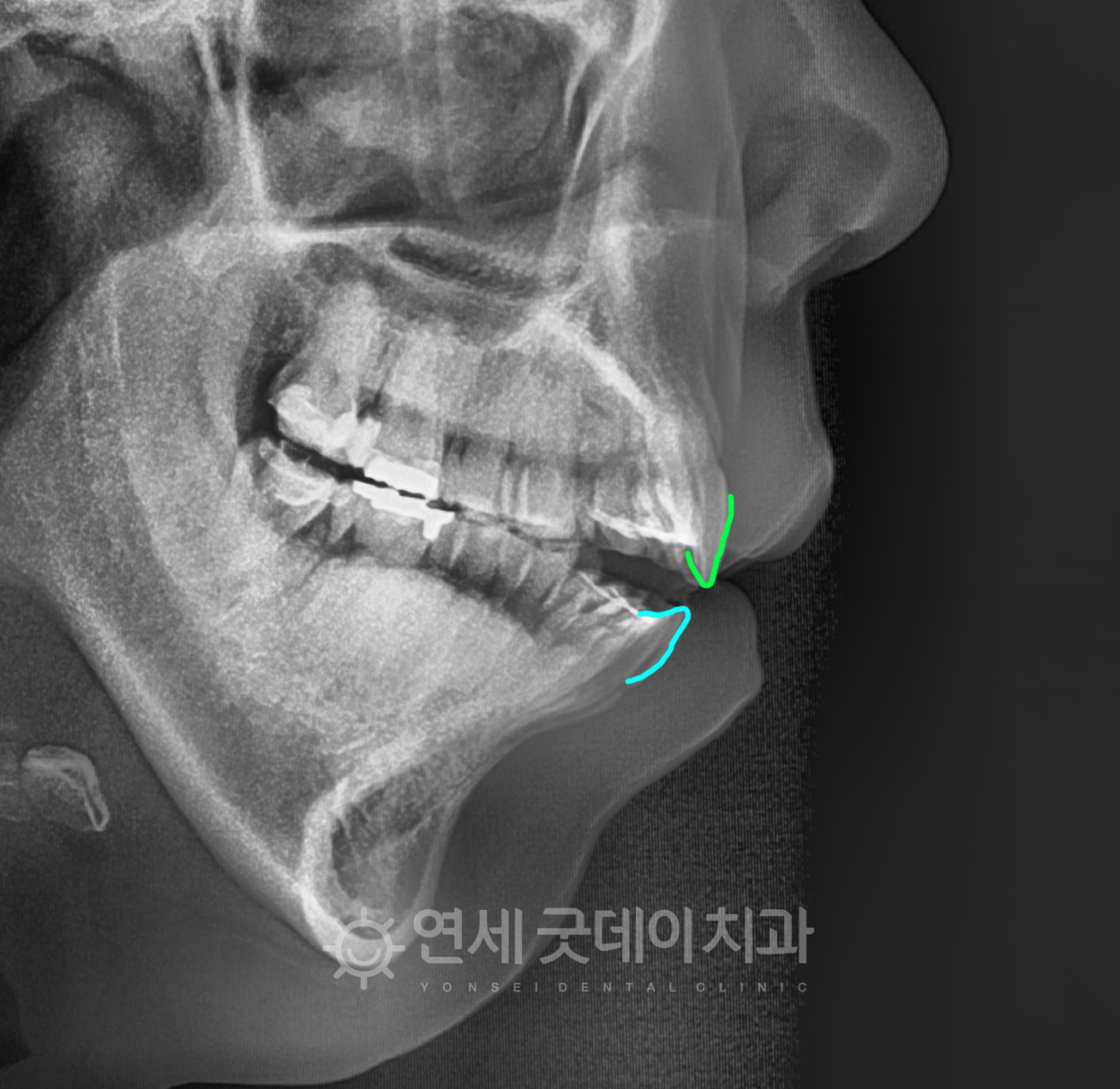 턱관절교정 치료 전 엑스레이 모습이며 위아래 치아가 상당히 많이 떠있는 것을 확인