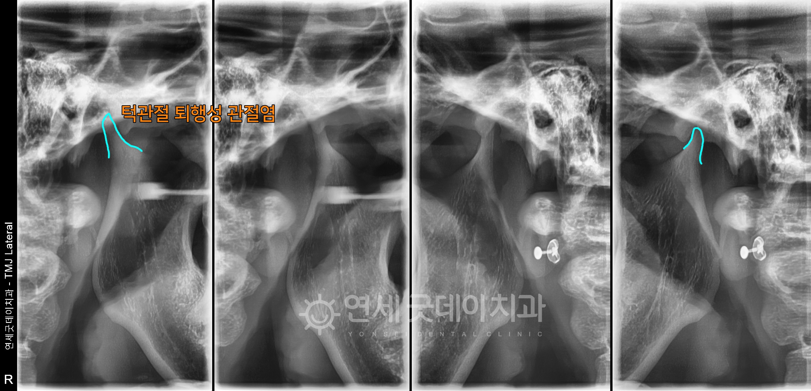 턱관절교정 전 턱관절 파노라마 모습이며 디스크가 닳아져 턱관절이 뾰족해진 상태