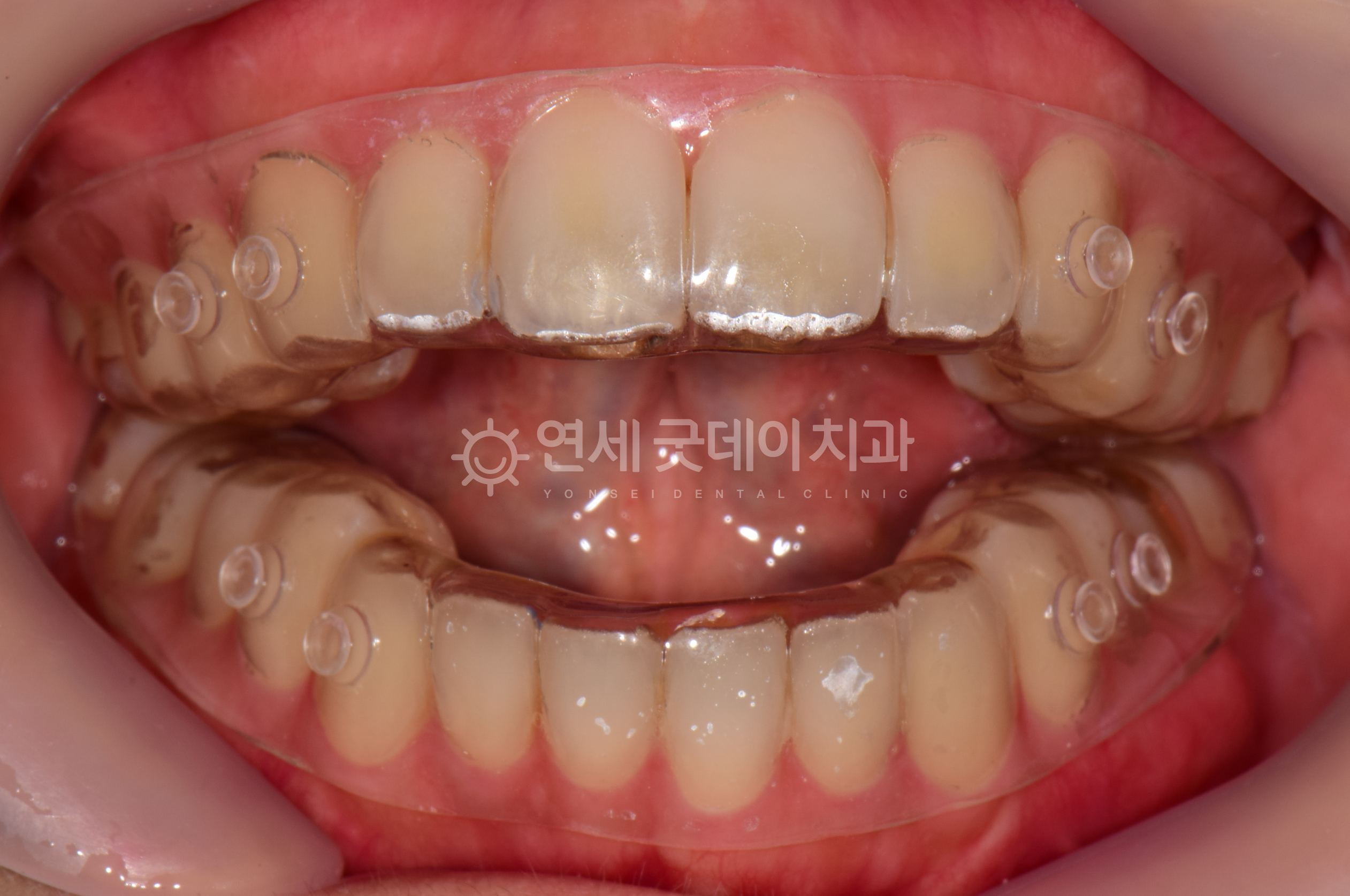 개방교합 양악수술 없이 트랙션 장치를 이용해 턱관절교정 치료 중인 모습