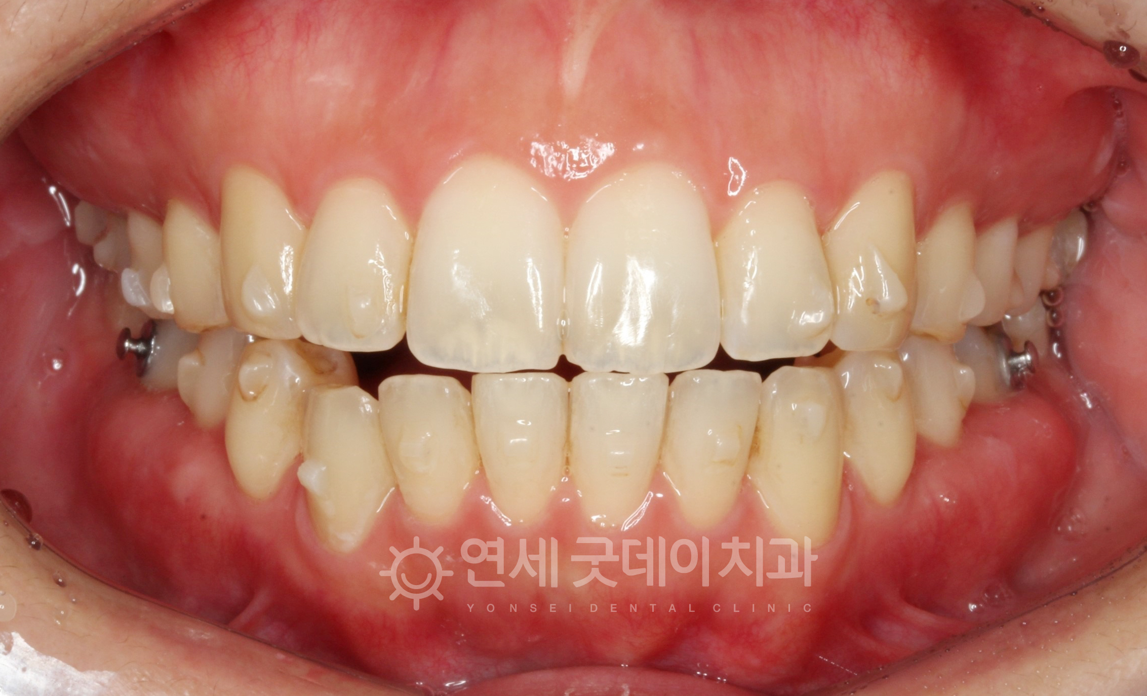 개방교합 양악수술 없이 턱관절교정이 진행되고 있는 모습 - 정면