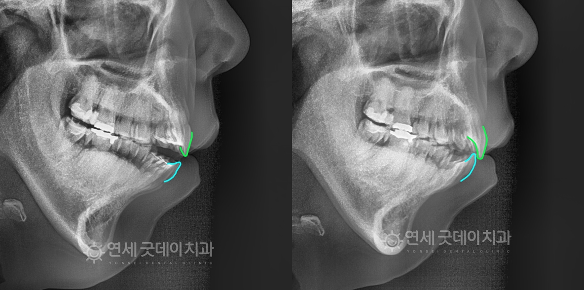 개방교합 양악수술 없이 턱관절교정을 통해 개선된 모습 - 엑스레이 비교