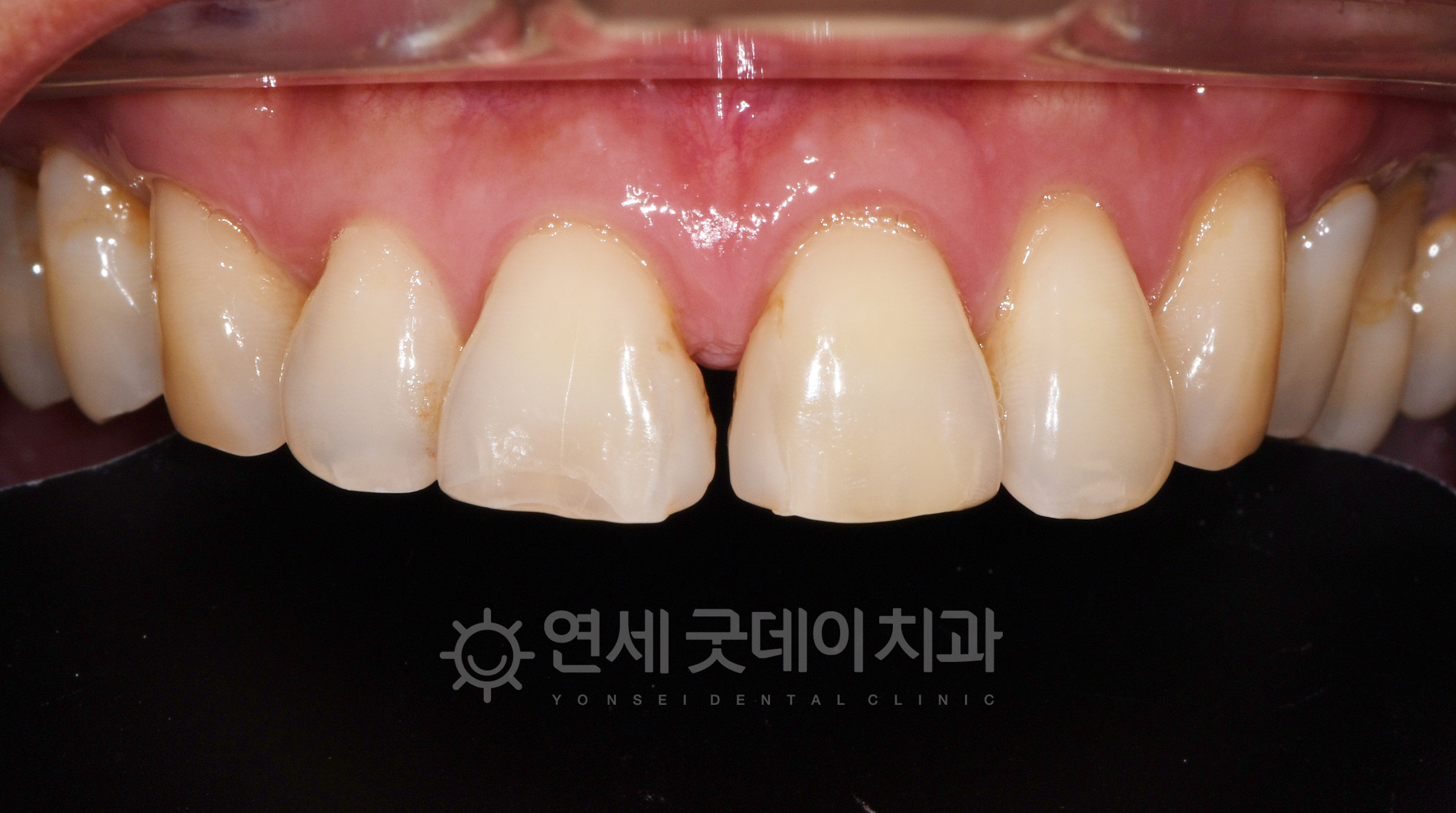 벌어진앞니레진 치료 전 모습이며 #11,21번 사이가 벌어져있음