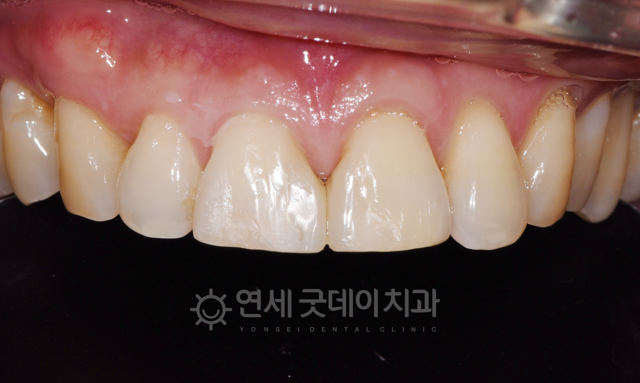 벌어진앞니레진 치료 후 모습이며 기존치아와 경계선 없이 자연스럽게 개선되었음