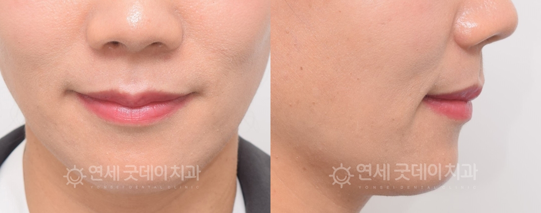 돌출입치아교정 발치교정 후 모습이며 입매라인이 살아난 모습