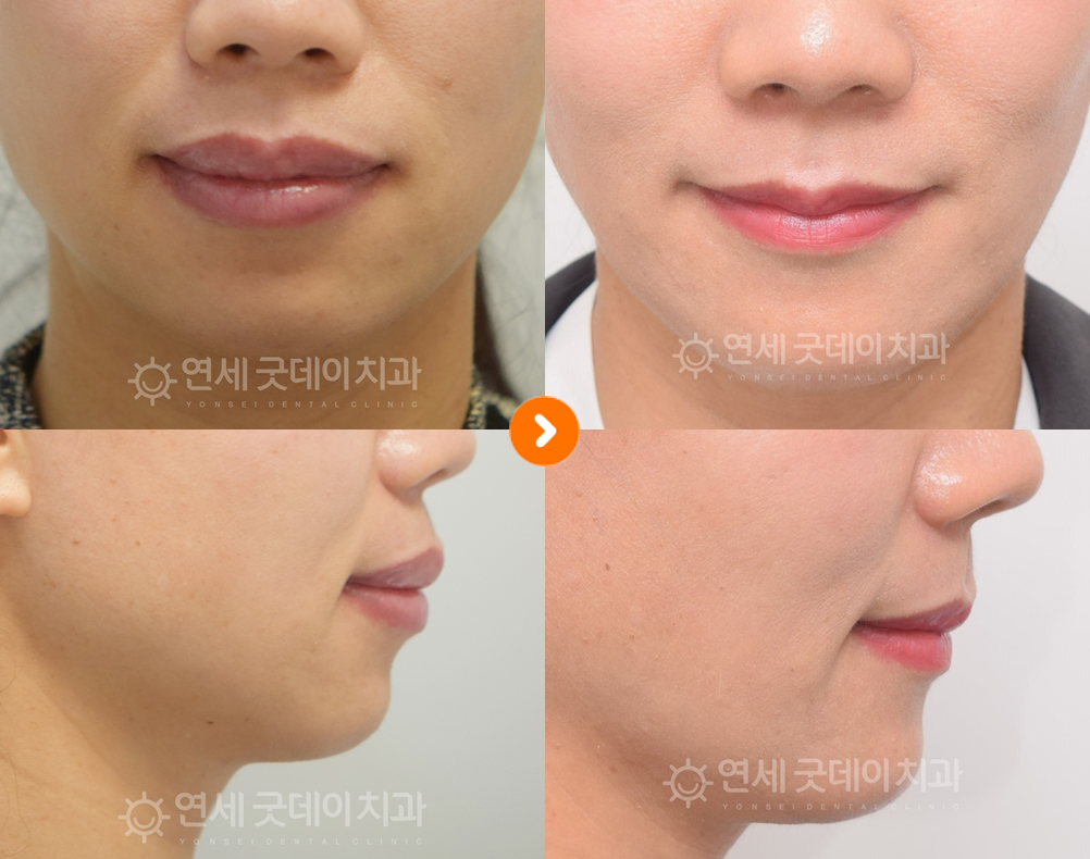 돌출입치아교정(발치교정) 치료전후 비교 모습