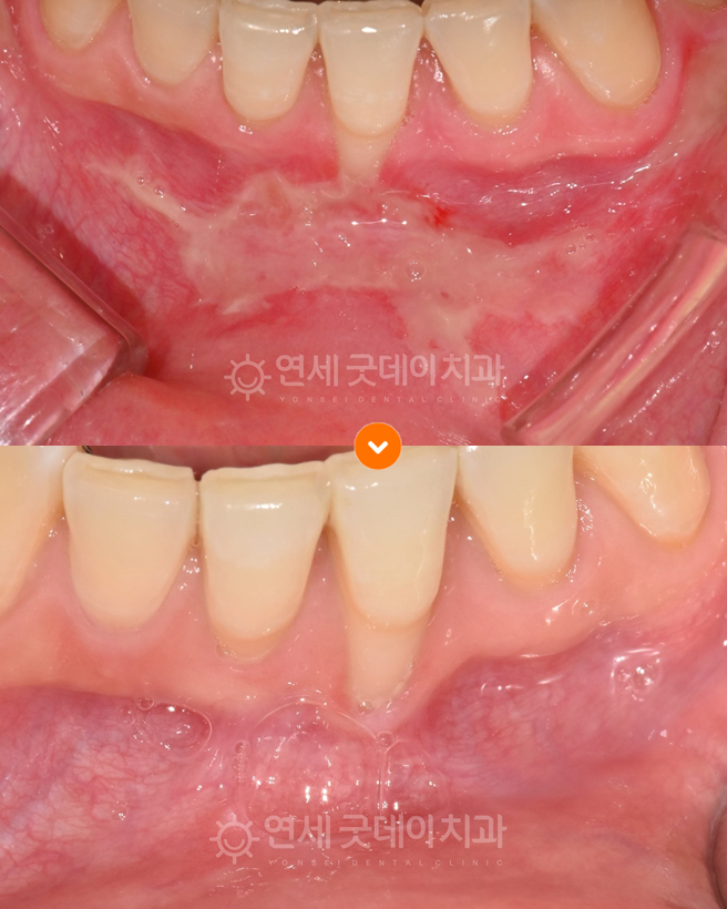 광범위한 잇몸궤양을 PDRN 잇몸재생주사로 치료한 전후비교