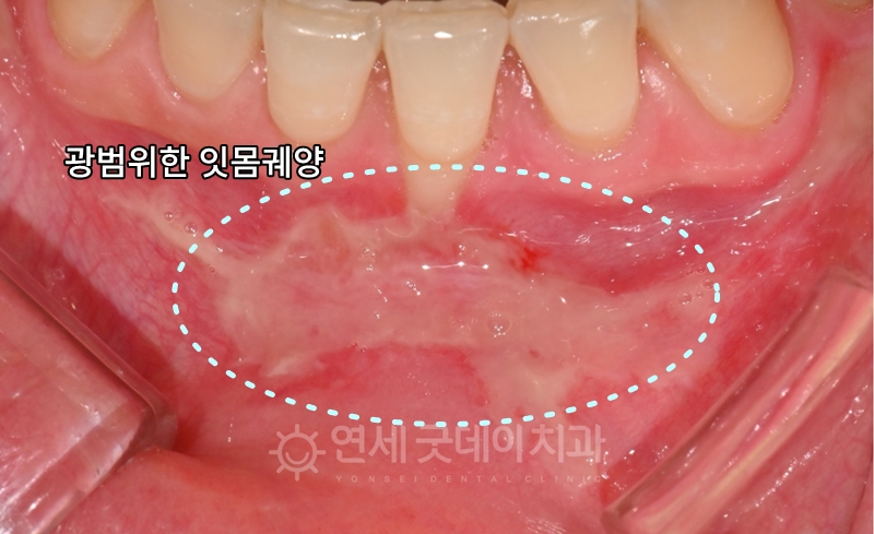 잇몸궤양으로 내원하신 환자분의 잇몸재생주사 PDRN 치료전 모습