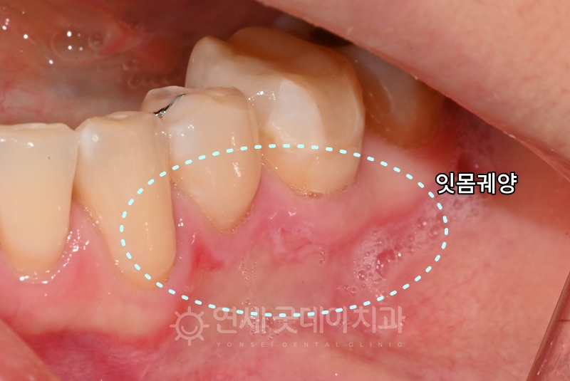 어금니쪽 잇몸궤양으로 내원하신 환자분의 잇몸재생주사 PDRN 치료전 모습