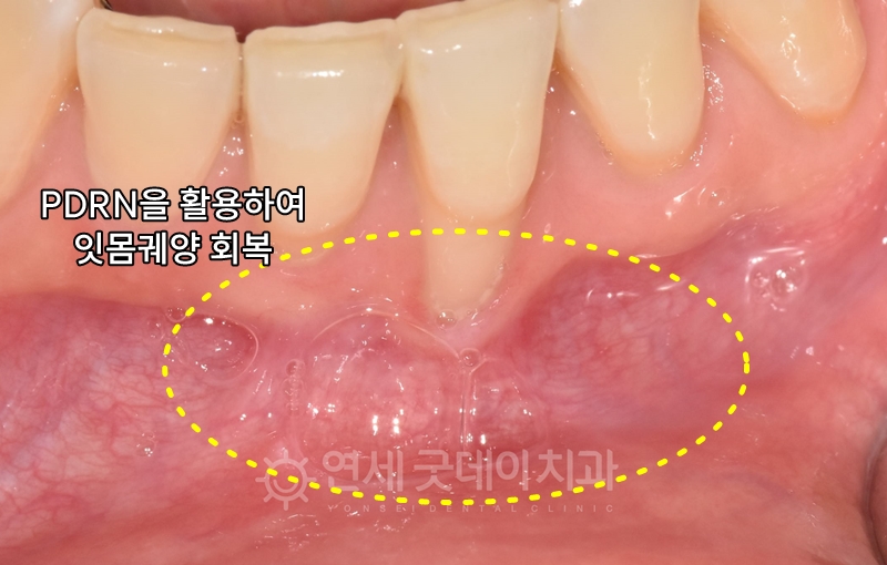 PDRN 잇몸재생주사 치료 후 잇몸궤양이 사라진 모습