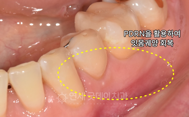 PDRN 잇몸재생주사 치료 후 어금니쪽 잇몸궤양이 개선된 모습