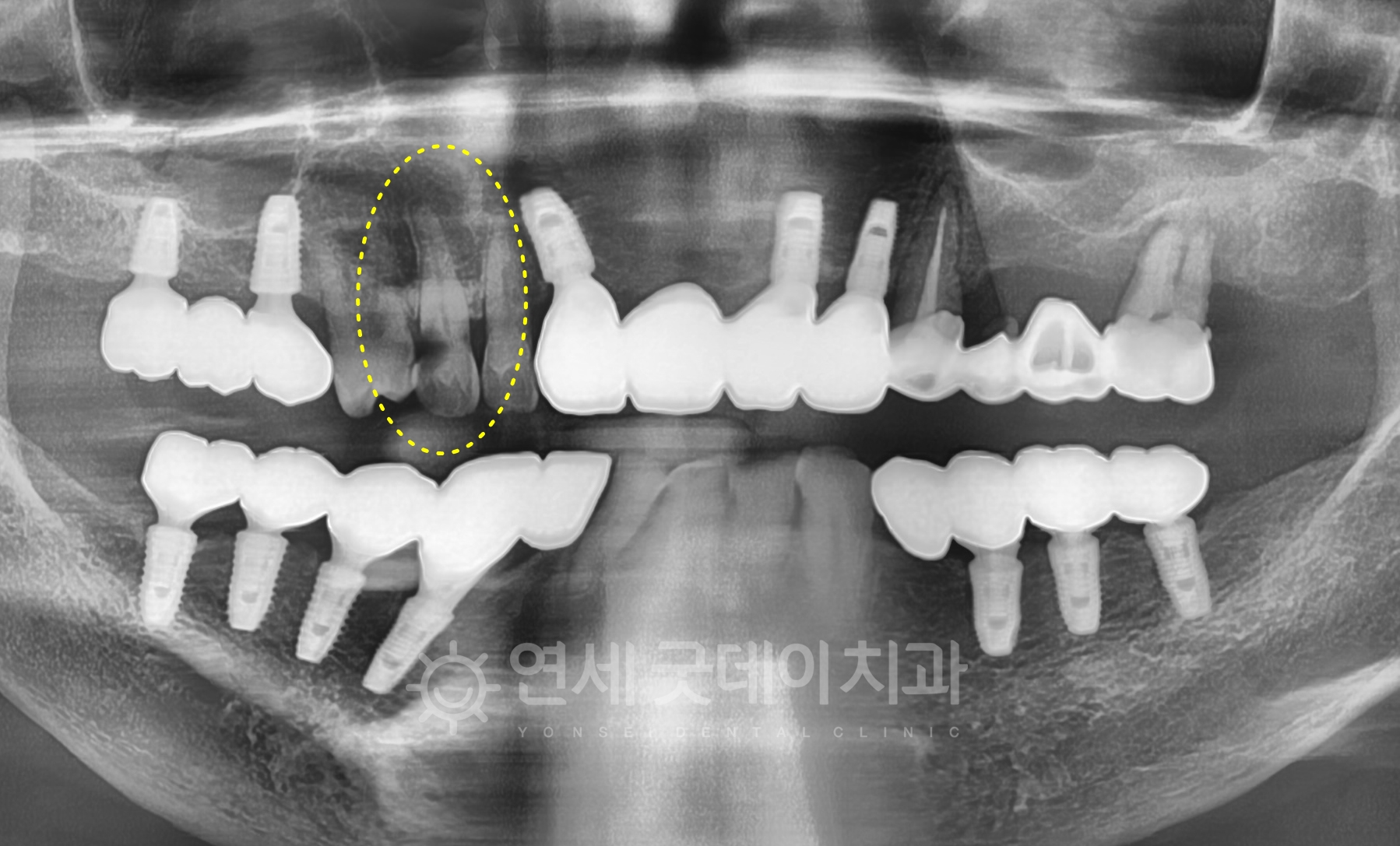 치아신경치료 전 엑스레이 촬영 모습이며 치과보존과에서 자연치아살리기 진행