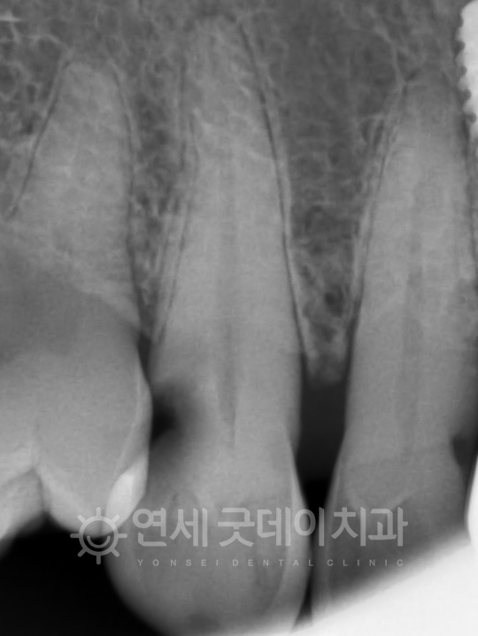 #13 치아 인접면에 충치가 생긴 모습이며 치아신경치료 치료계획 수립