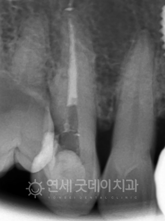 치아신경치료 진행 중인 모습