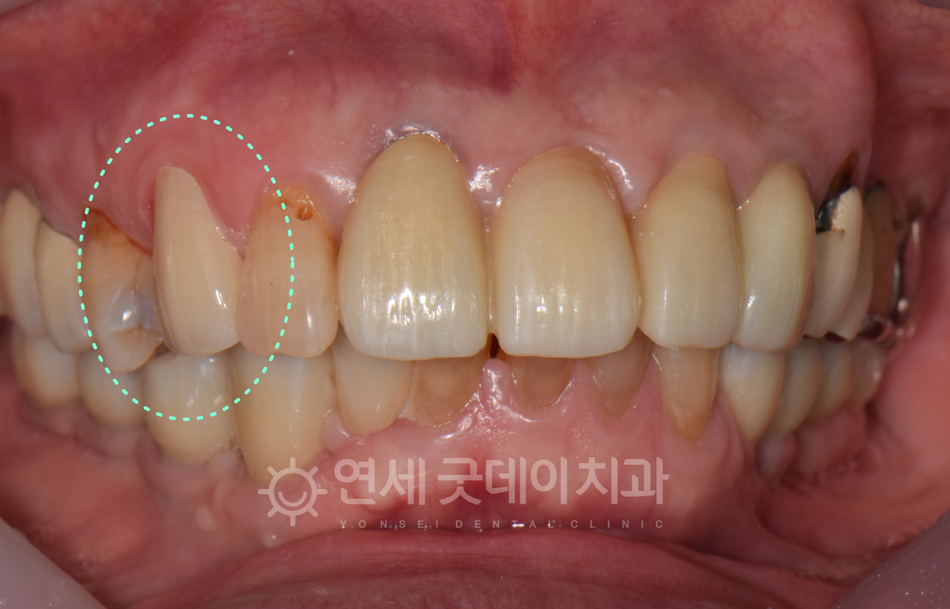 자연치아살리기 치아신경치료 완료 후 모습이며 문제되는 신경관을 모두 제거하여 건강해진 모습