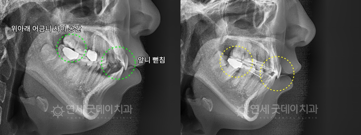 인비절라인 돌출입 발치교정 치료 전후 비교 - 엑스레이