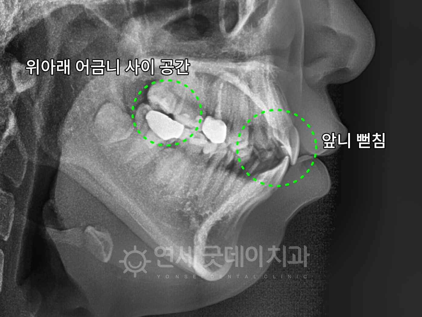 인비절라인 돌출입 발치교정 치료전 엑스레이