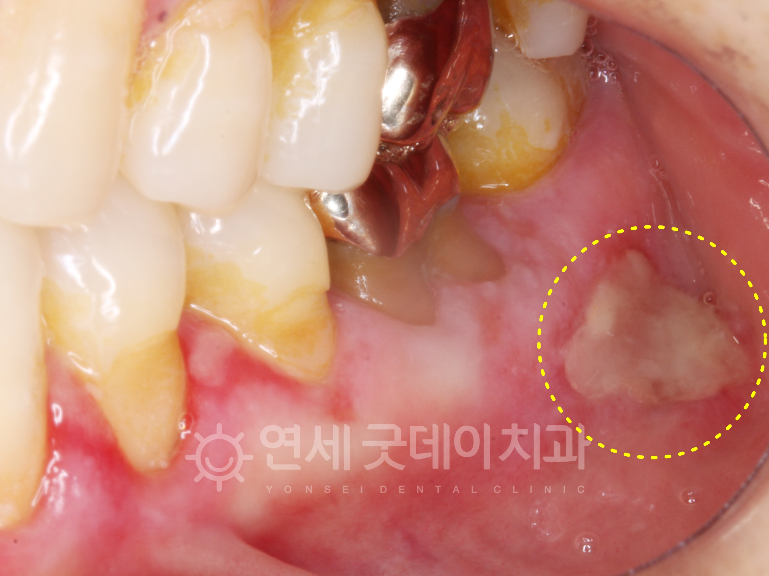 잇몸 헐었을때 PDRN 연어주사 적용하기 전 모습