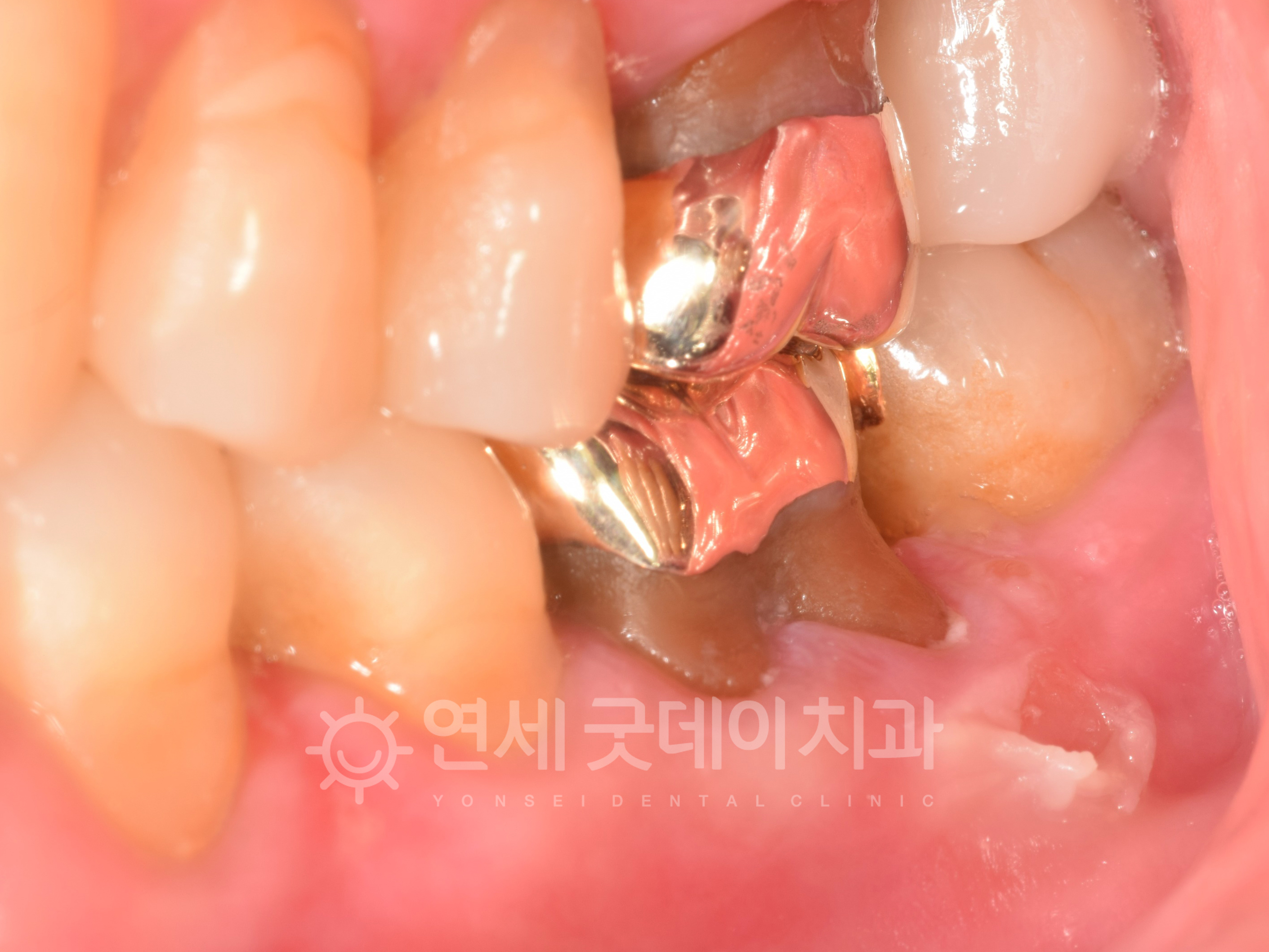 잇몸 헐었을때 PDRN 연어주사 적용 후 모습