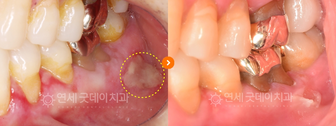 잇몸 헐었을때 PDRN 연어주사 적용 전후비교