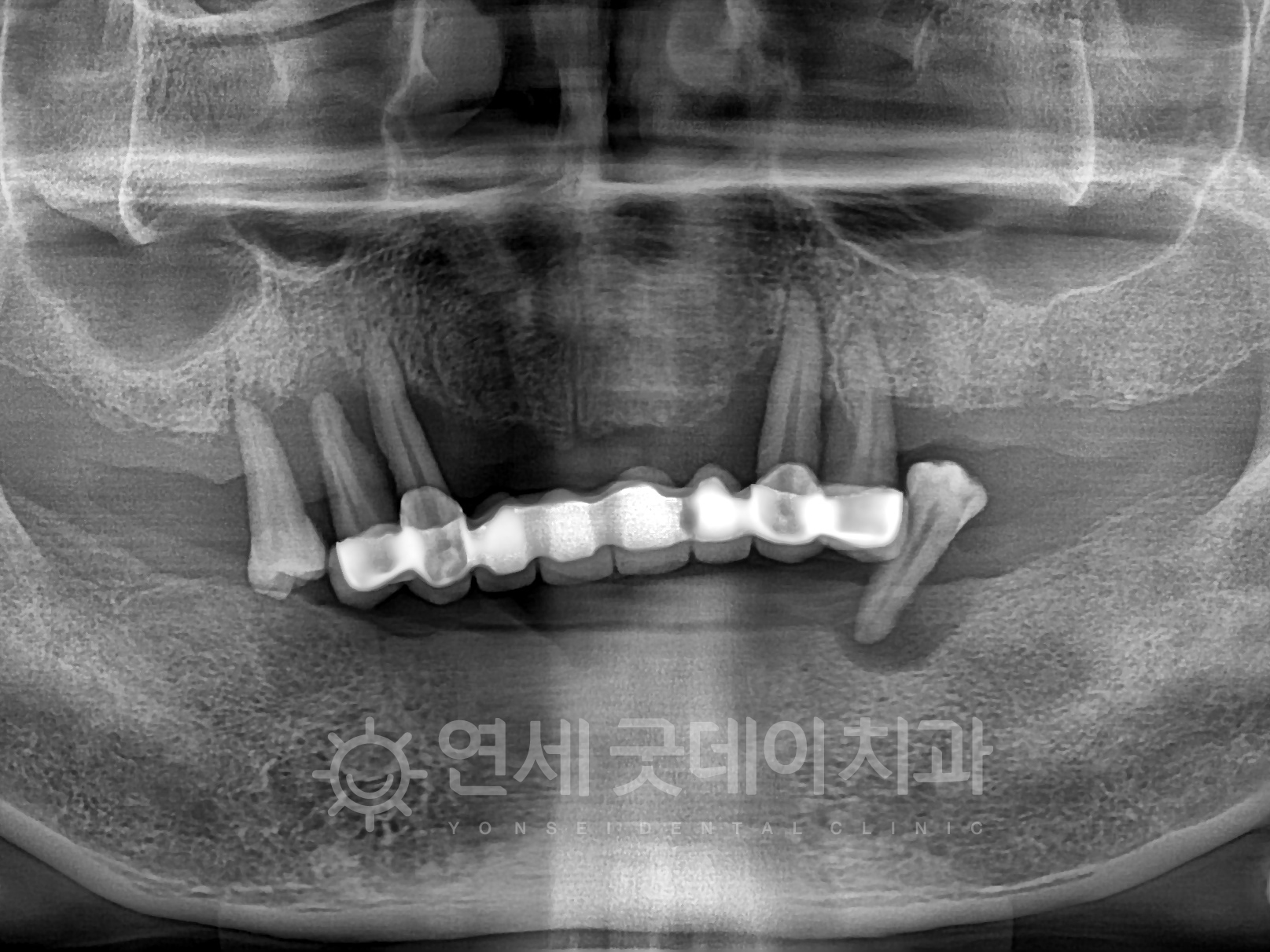 수면임플란트 치료 전 엑스레이이며 잇몸뼈가 거의 다 녹아있는 모습