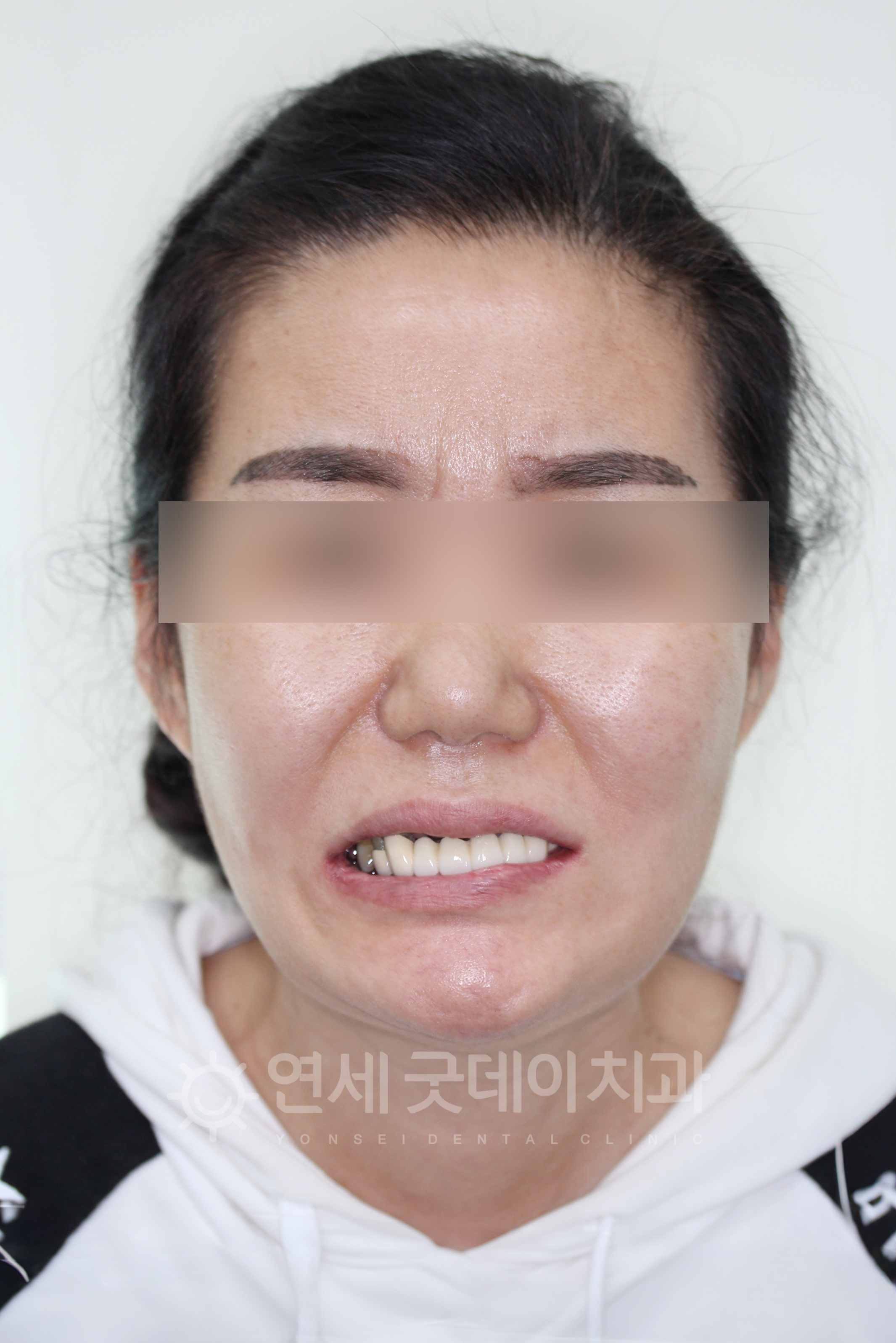수면임플란트 치료 전의 얼굴
