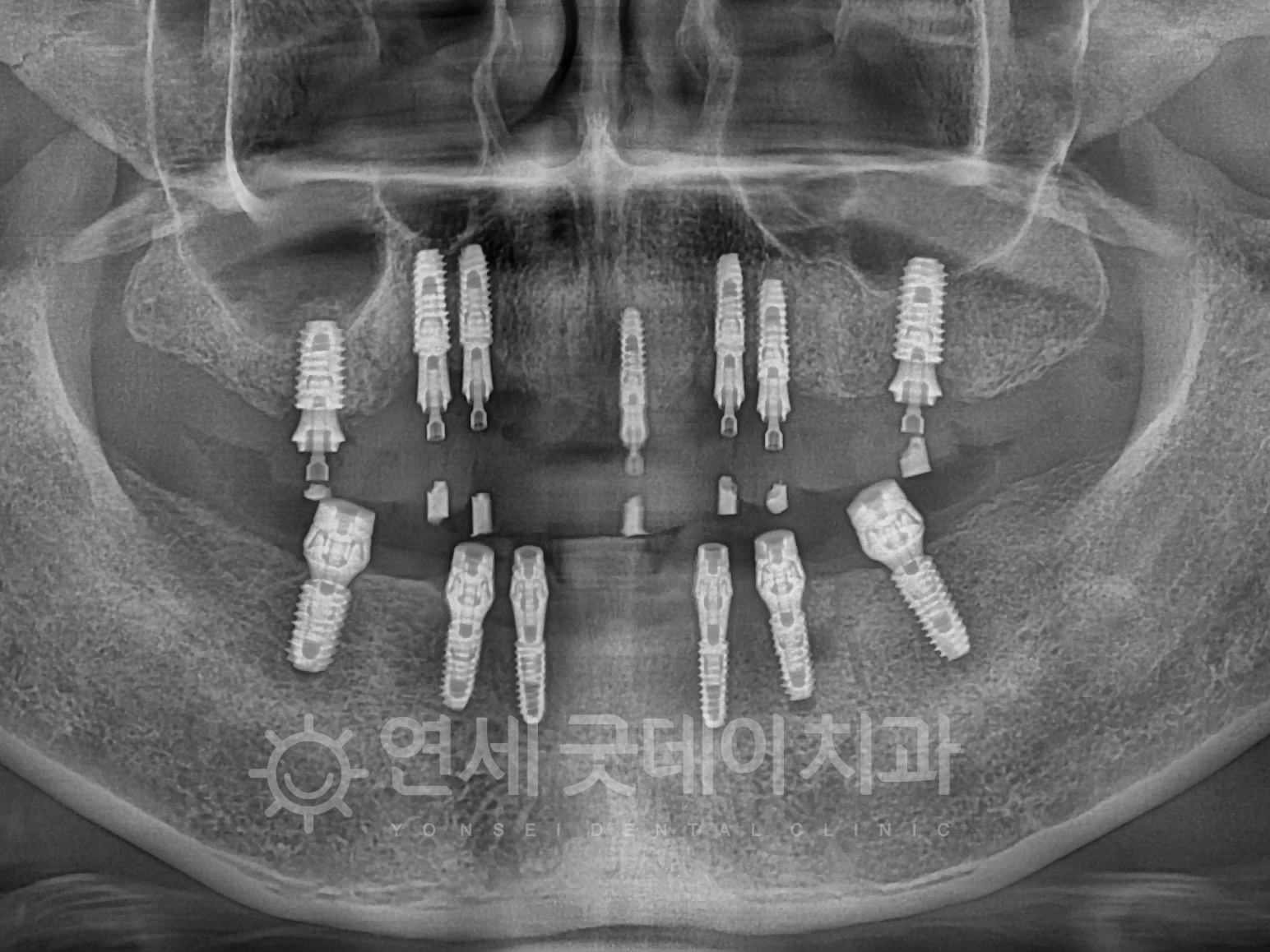 수면임플란트 치료 중이며 두툼한 잇몸뼈 위로 임플란트가 잘 심어졌음