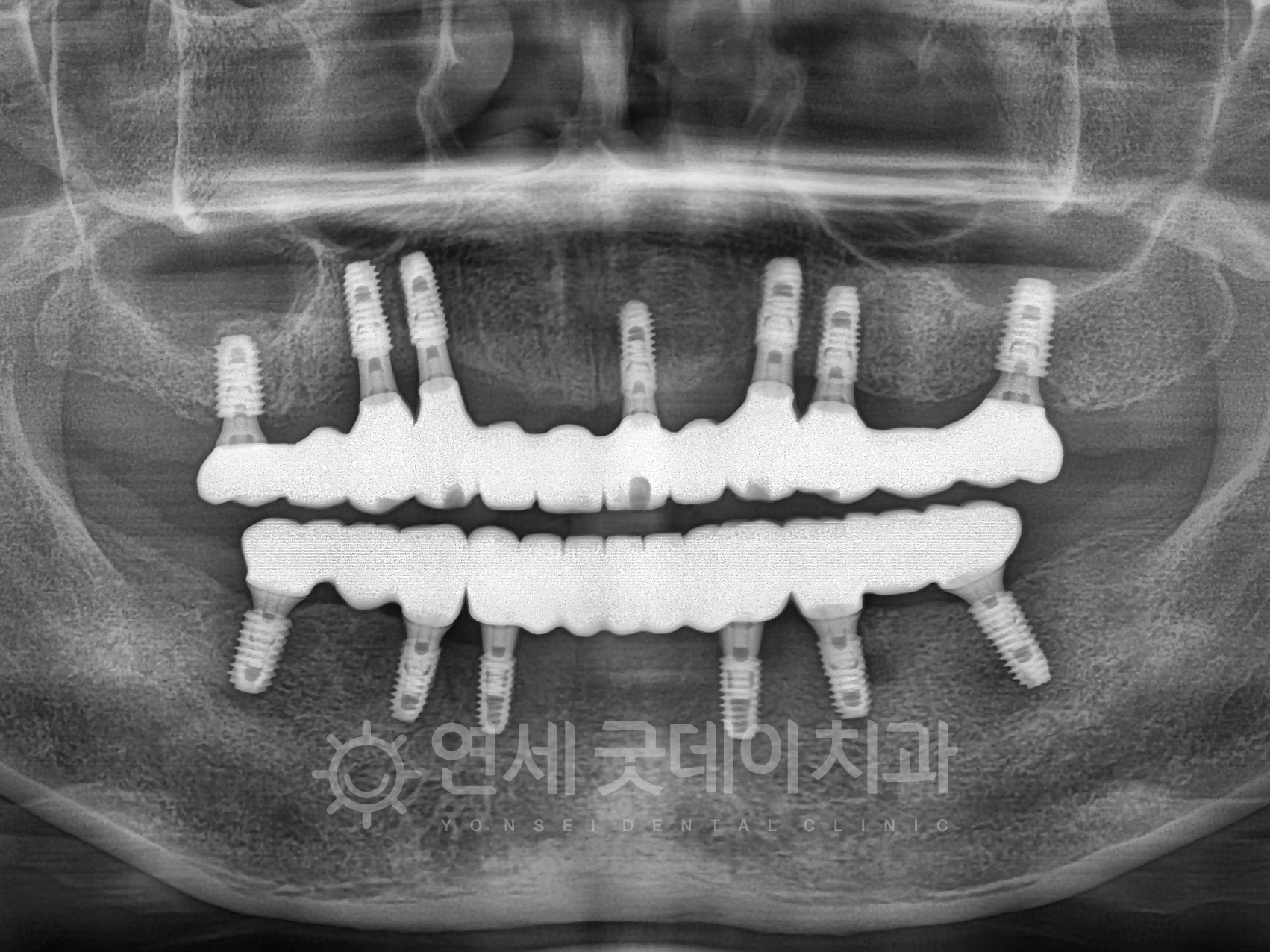 수면임플란트 치료완료