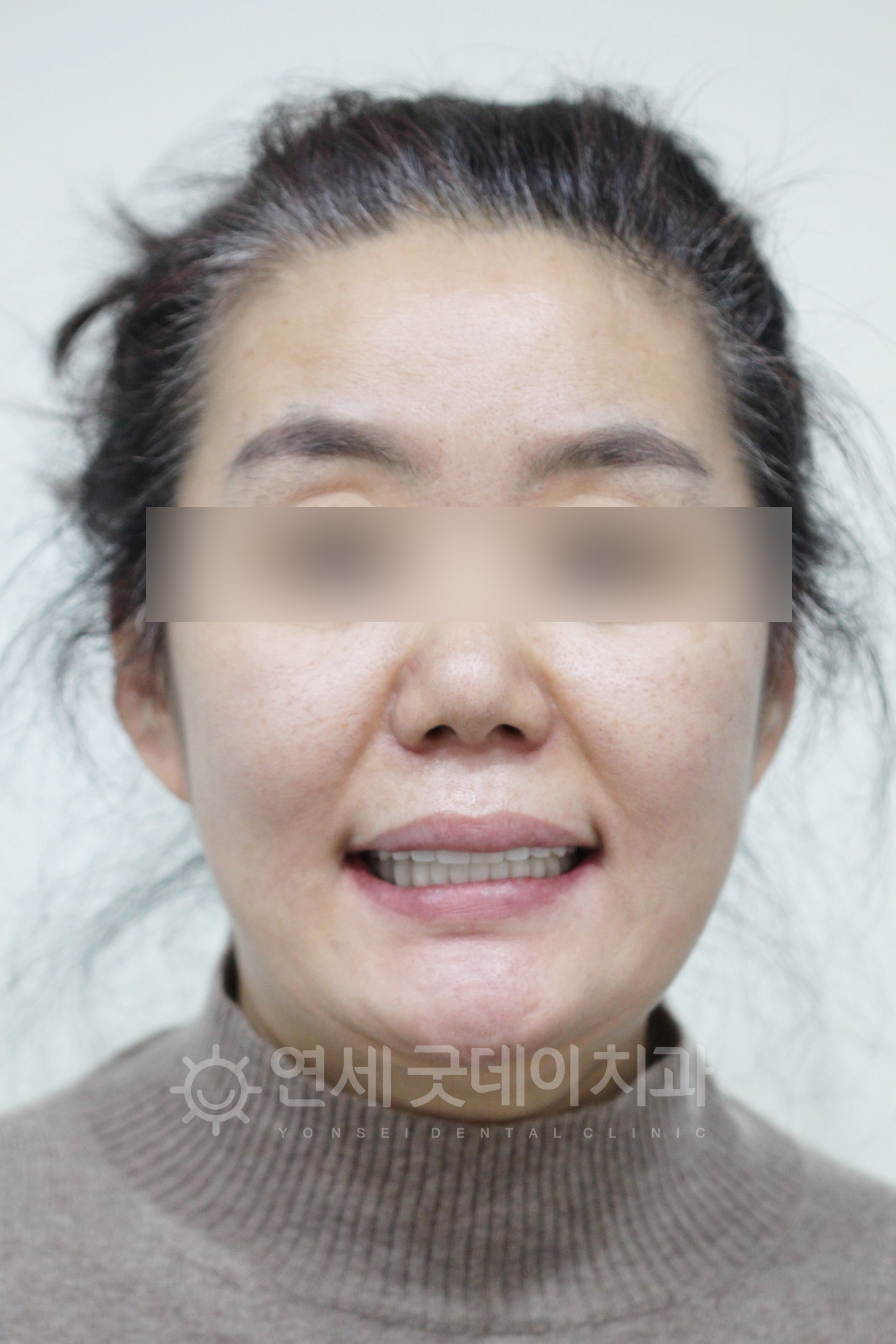 수면임플란트 치료 후 한층 더 젊어보이고 건강해진 얼굴