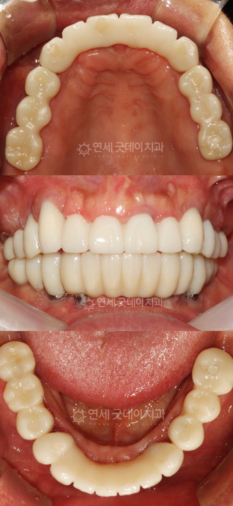 수면임플란트 치료 후 구내 모습