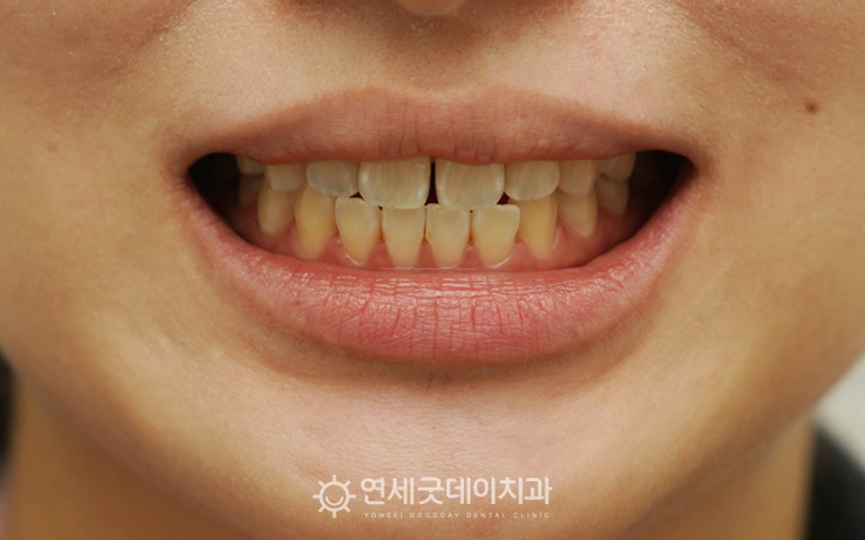 절단교합 및 벌어진앞니교정을 주소로 내원하신 20대 환자분의 안모
