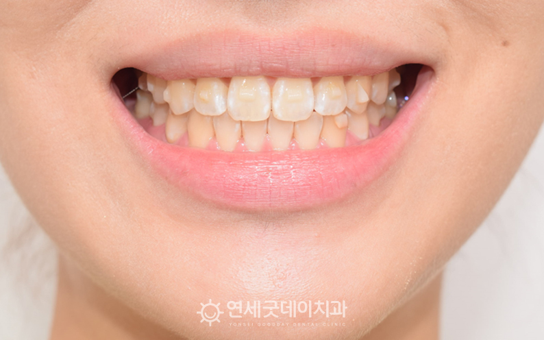 인비절라인을 통한 벌어진앞니교정 및 절단교합 치료 진행중