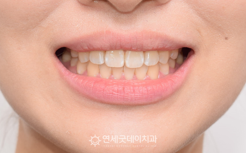 절단교합 및 벌어진앞니교정 완료 후 안모