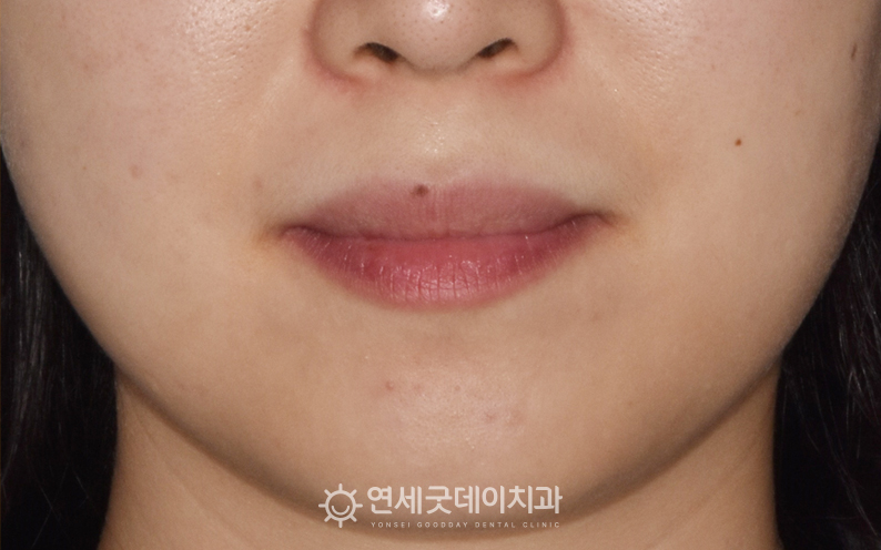 웃을때잇몸 드러나는 주소로 입술재배치술 잇몸교정 희망 - 치료전