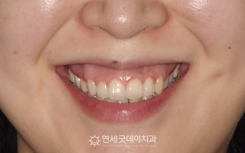 입술재배치술, 잇몸교정 전 모습이며 웃을때 잇몸이 많이 드러남