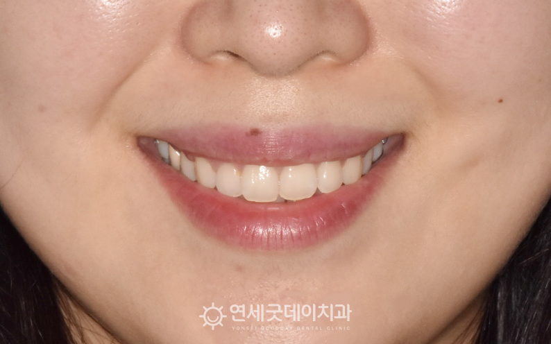 입술재배치술을 통한 잇몸교정 후 모습이며, 웃을때잇몸이 많이 드러나지 않음
