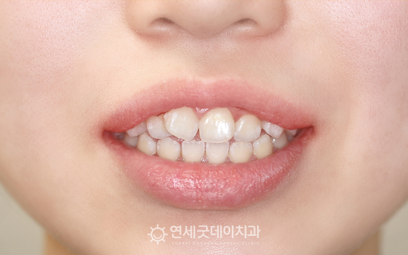 돌출입치아교정을 주소로 내원한 20대 여성 교정전 모습