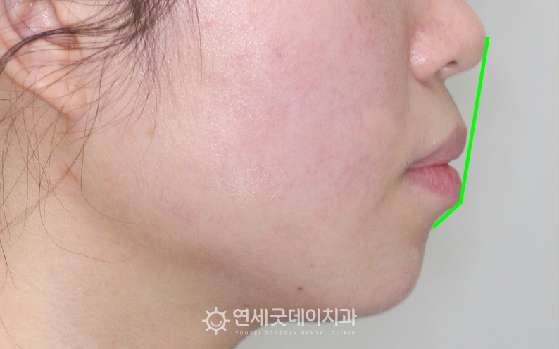 측면에서 바라본 돌출입치아교정 전 모습. 발치교정을 통해 돌출해소 예정