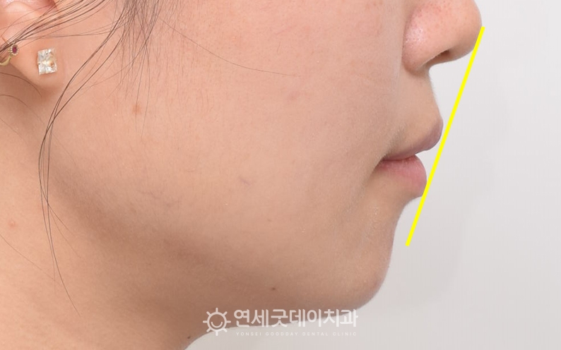 돌출입치아교정 후 발치교정 후 공간으로 치아가 이동하며 돌출감 해소됨