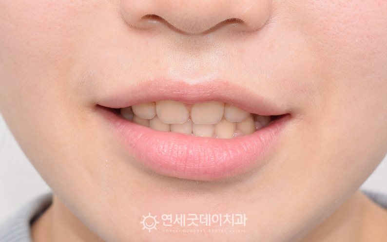 돌출입치아교정 발치교정 후 더욱 깔끔해진 인상을 주고 있음